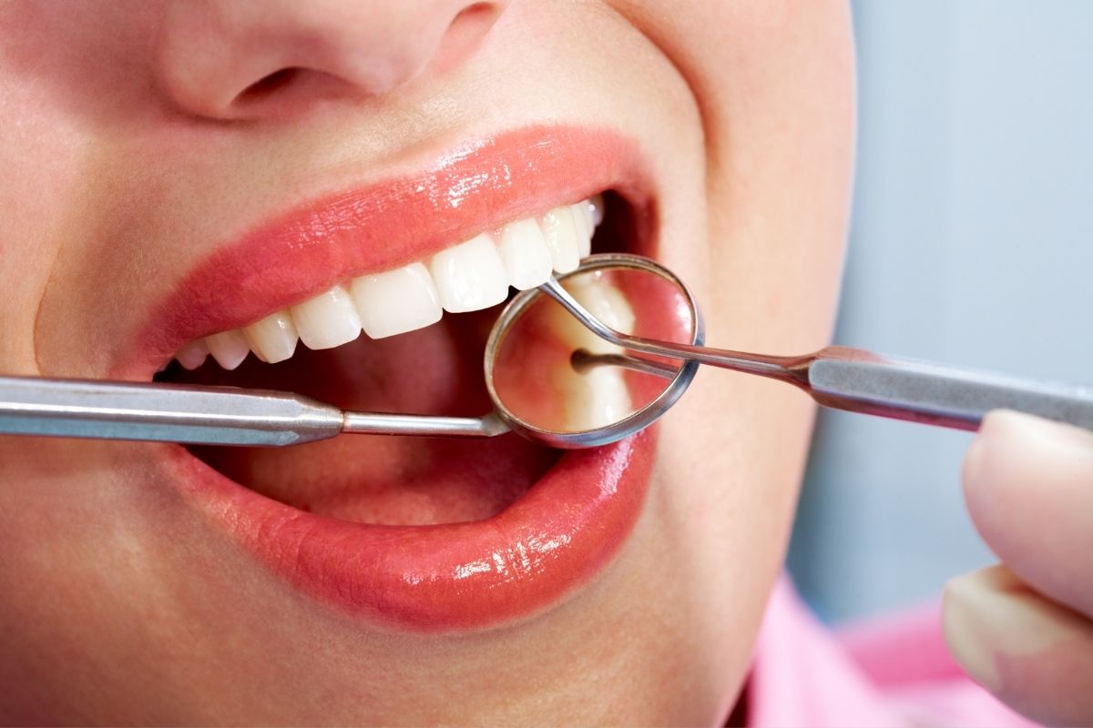 Teeth Cleaning in Alanya | Affordable & Gentle Dental Care